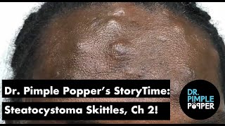 Dr. Pimple Popper's Weekly Story: Steatocystoma Skittles, Chapter 2