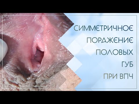 Симметричное поражение половых губ при ВПЧ. Клинический случай №13