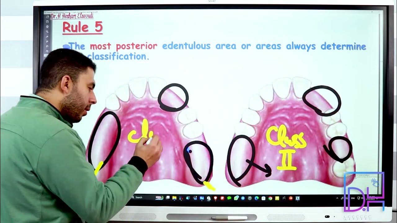 3 Applegate's Rules for applying Kennedy classification YouTube