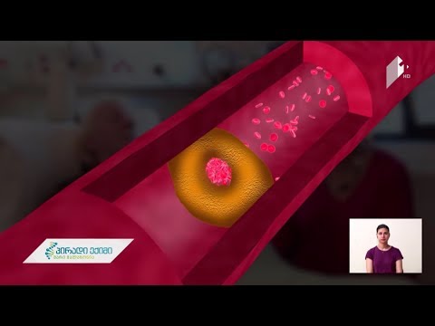 #პირადიექიმი - მიღწევები მძიმე, მწვავე ინსულტის მკურნალობაში