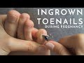 How to Manage Ingrown Toenails During Pregnancy - Podiatrist Georgina Tay, East Coast Podiatry