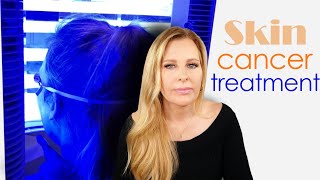 Skin Cancer Treatment Levulan Blue Light Therapy | My Full Experience