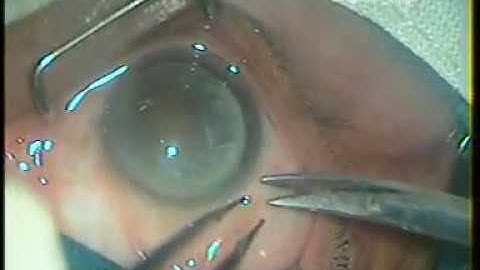 Intra tunnel Phacofracture SICS in Rock Hard Nuclear Cataract