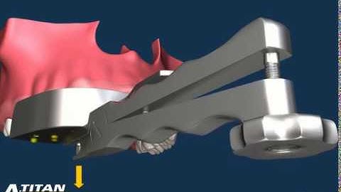 Perform an extraction easy as 1..2..3 with the Easy X Trac system