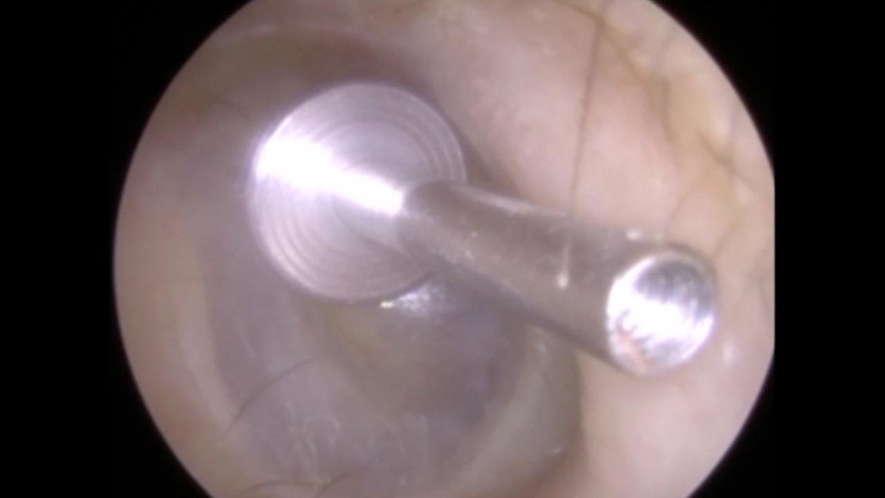 Aggregate more than 66 earring in ear canal