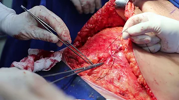 Qual o valor de uma cirurgia para tirar gordura da barriga?