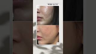 맑은선의원 여드름 시술 전후 확인하세요! #여드름 #여드름치료 #선릉피부과 #선릉역피부과