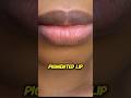 If you have a  normal skin problem #bummpy skin #dark circle #dark lip#uneventone#pigmanted lips