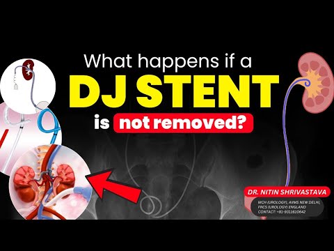 PCNL Surgery for Large Kidney Stones – Dr. Nitin Shrivastava