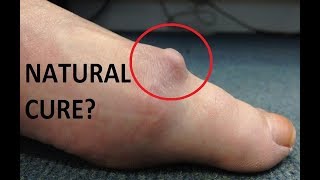 Big Toe Joint Arthritis **Natural Home Treatment TRUTH**