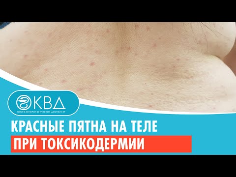 👉 Красные пятна на теле при токсикодермии. Клинический случай №908