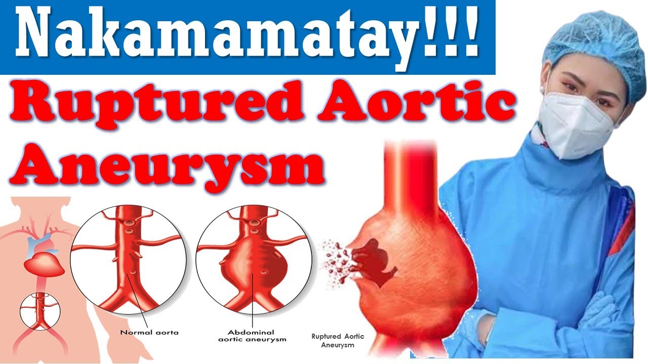 Ruptured Aortic Aneurysm Silent Killer Cause Of Sudden Death YouTube