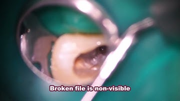 Removal of a non-visible broken file from beyond the curve/見えない破折器具の除去