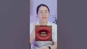 Niềng răng có làm môi bớt dày đi không?| Lạc Việt Intech Niềng Răng #shorts