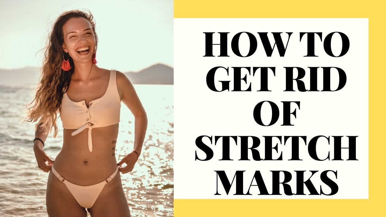 10 Ways To Avoid Stretch Marks YouTube