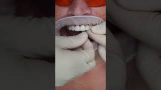 Short dental implants Short All on 4 Video #shorts #dentist #dental #implant #veneers #short