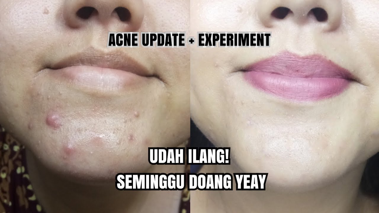 Acne Update : Seminggu hilangkan jerawat dengan 2 produk saja | Khansamanda