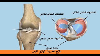 علاج تمزق الغضروف الهلالي المزمن الجزء الثاني|علاج اصابة الغضروف المزمن| علاج تنكس الغضروف الهلالي