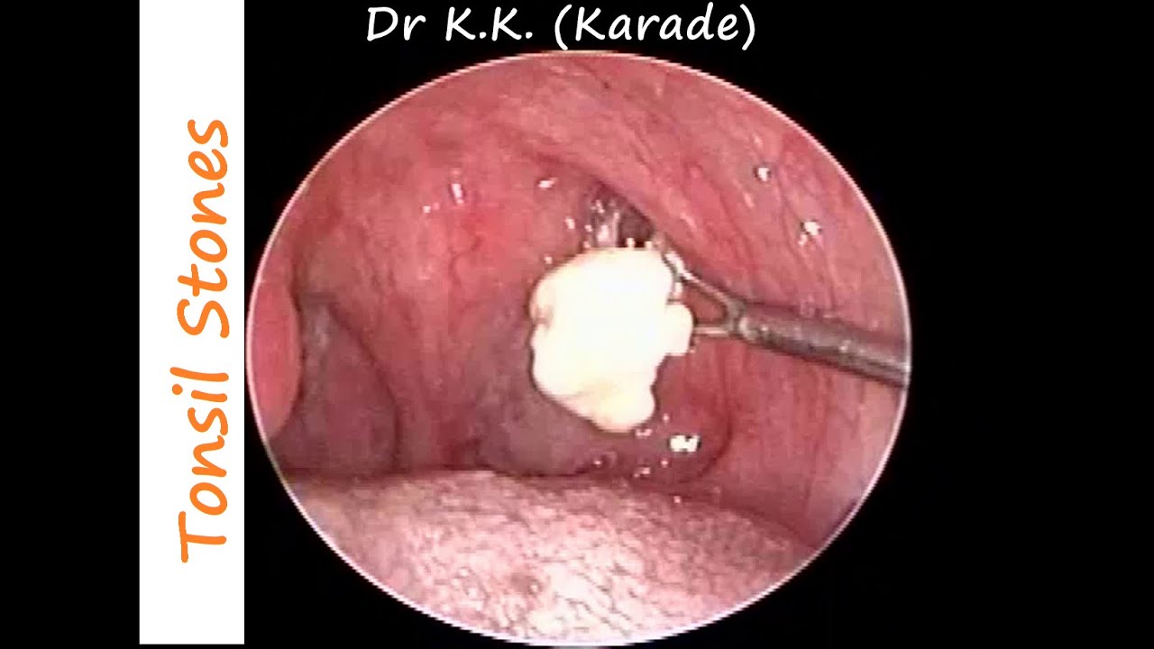 Huge Tonsil Stones Removal In A Case Of Chronic Tonsillitis Allergic