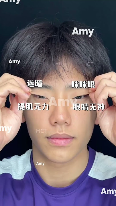 Squinting eyes have been successfully modified! #医美 #plastic #medicalbeauty #eyes #doubleeyelids