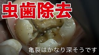 【虫歯治療】ドリルで削る！最先端のプロ技術