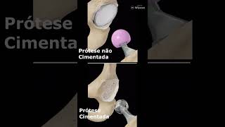 What is the Difference Between a Cemented and an Uncemented Hip Replacement