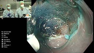 Prof. Stefan Seewald performs an oesophageal ESD at London Live Endoscopy 2021 screenshot 4