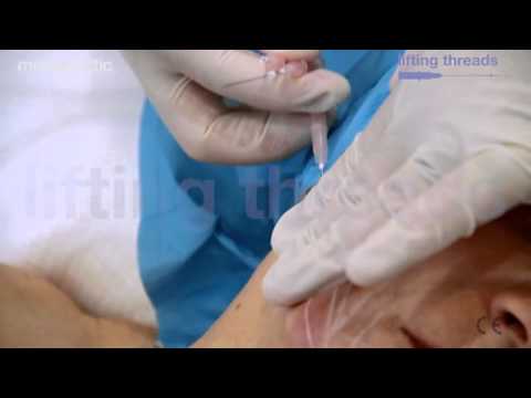 PDO Lifting Threads By Mesoestetic