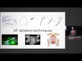 Catheter Ablation for Atrial Fibrillation - Dr Anderi Catanchin