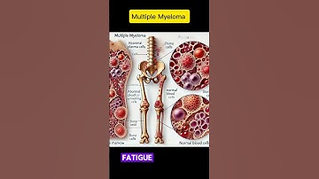 "Understanding Multiple Myeloma: Signs, Risks, and Treatment Options"