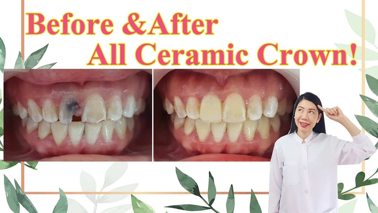 BEFORE and AFTER All Ceramic Crowns YouTube