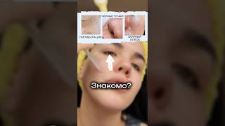 Знакомо?WW123364(вб)пилинг от прыщей Cosmeya#черныеточки #постакне