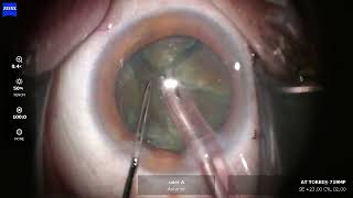 OS 2026 07 07 102957 Phaco Torbi