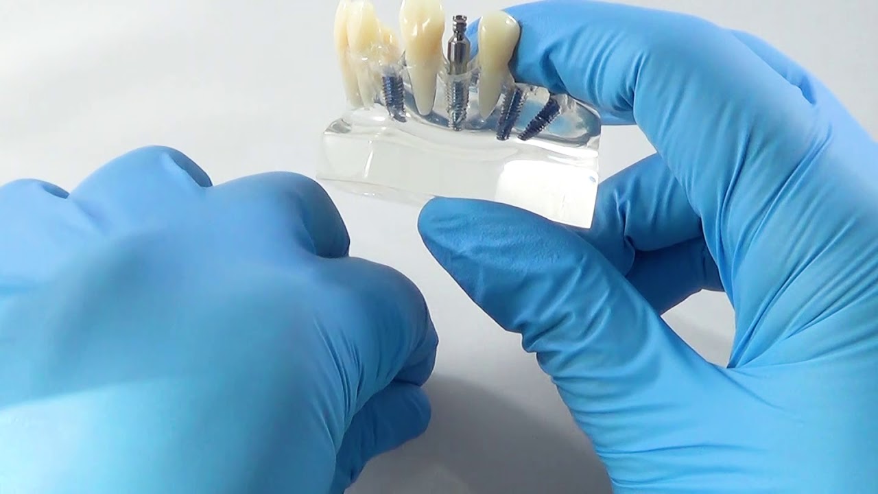 Neodent Closed tray Impression Coping Technique YouTube