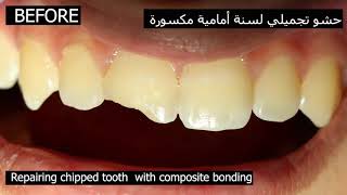 Chipped Front Tooth Repair | Dentist repair broken tooth with Composite Bonding