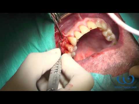 Video: Parodontisk Kirurgi: Beredning, Procedur, återhämtning, Kostnad Och Mer