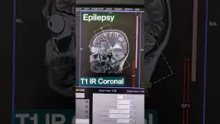 Brain epilepsy protocol planning perpendicular to hippocampus screenshot 2