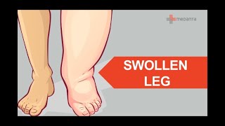 Know In detail About Causes, sign & symptoms of Swollen Legs - Dr Rajiv Parakh