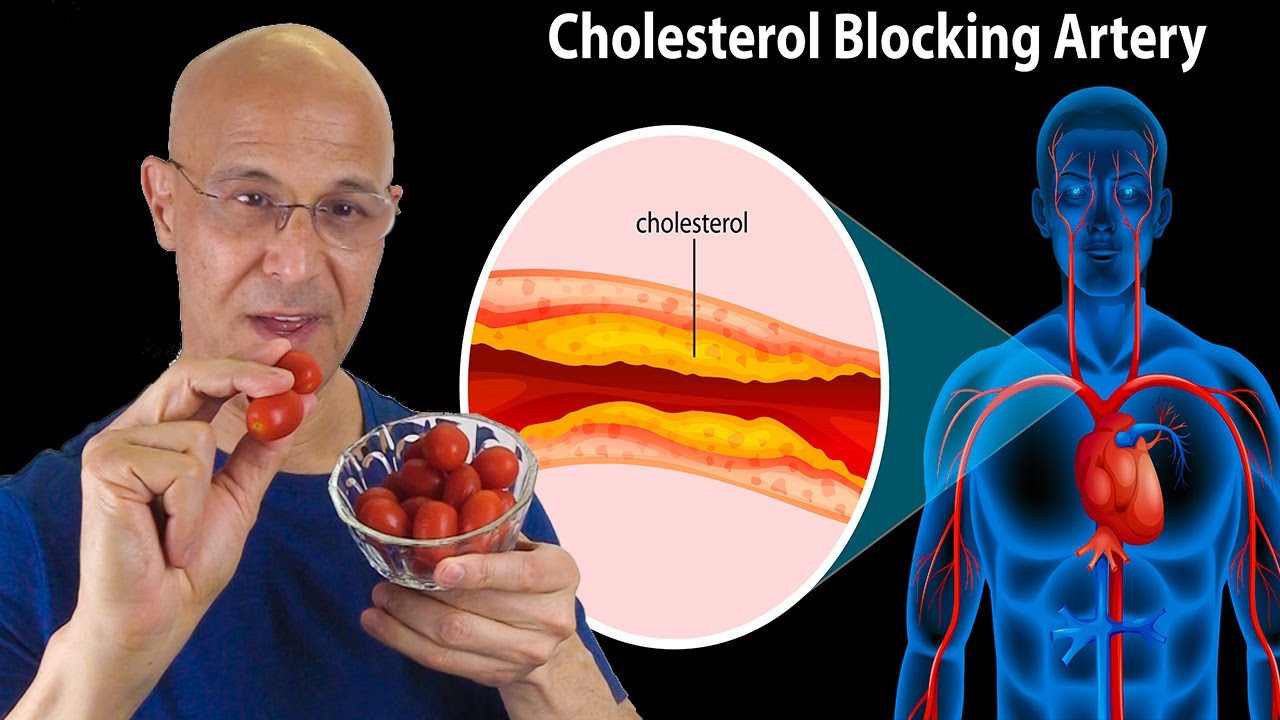 Инсульт холестерин