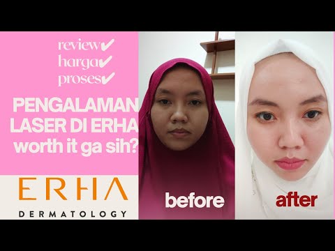 Video: Perawatan Periodontal: Biaya, Laser, Fase, Opsi, Dan Lainnya