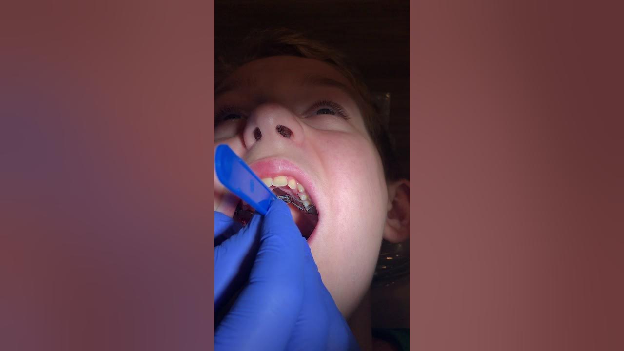 How to Turn a Palate Expander YouTube