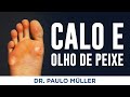 Calo e Olho de Peixe - Dr. Paulo Müller Dermatologista.