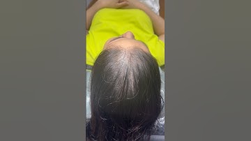 Xem ngay biết đâu bạn cần, tóc hói , thưa tóc đỉnh đầu #xămtóc #reviewxămtóc