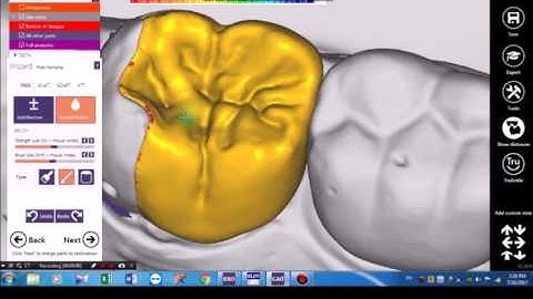 Onlay Exocad Design part 2