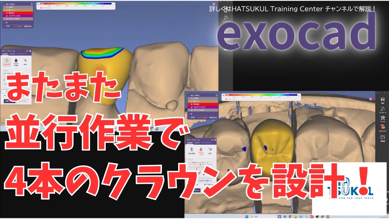 #204　またまたexocad設計　4本のクラウンを同時に並行設計！（解説なし版）