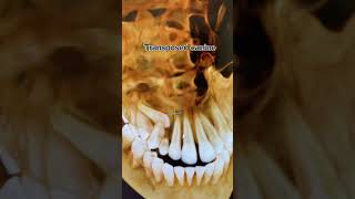 Crazy canine. Going the wrong direction. #shorts #braces #invisalign #orthodontics