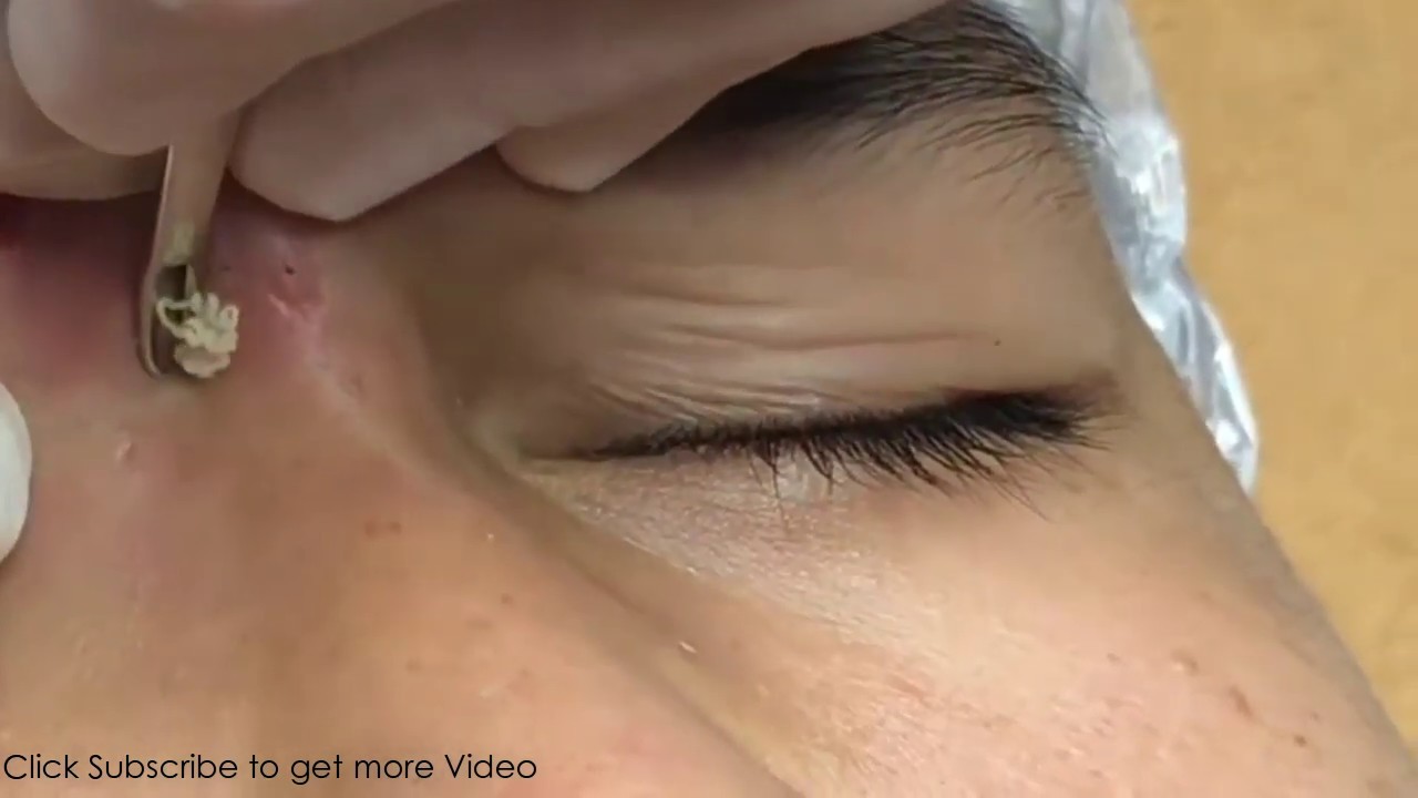 Whiteheads Extraction 2019, Milia, Acne treatment YouTube