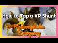 Tapping a VP Shunt for a Hydrocephalus Emergency