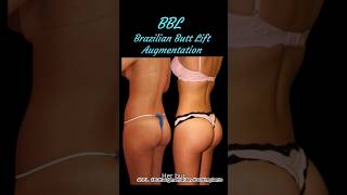 BBL Brazilian Butt Lift  or Butt Augmentation #bbl #Buttaugmentation