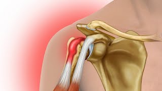 боль в плече - тендинит длинной головки бицепса (перезапись)